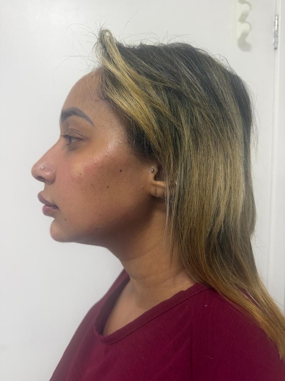 Perfil da paciente depois da harmonização facial na Apapele