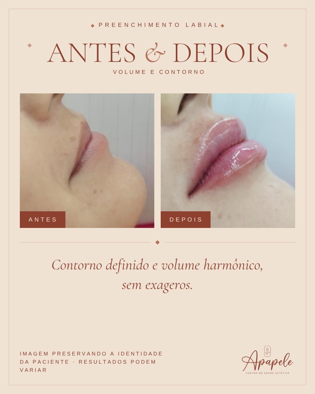 Comparativo antes e depois de preenchimento labial realizado na Apapele, com o perfil da paciente fotografado no mesmo ângulo antes e depois da sessão