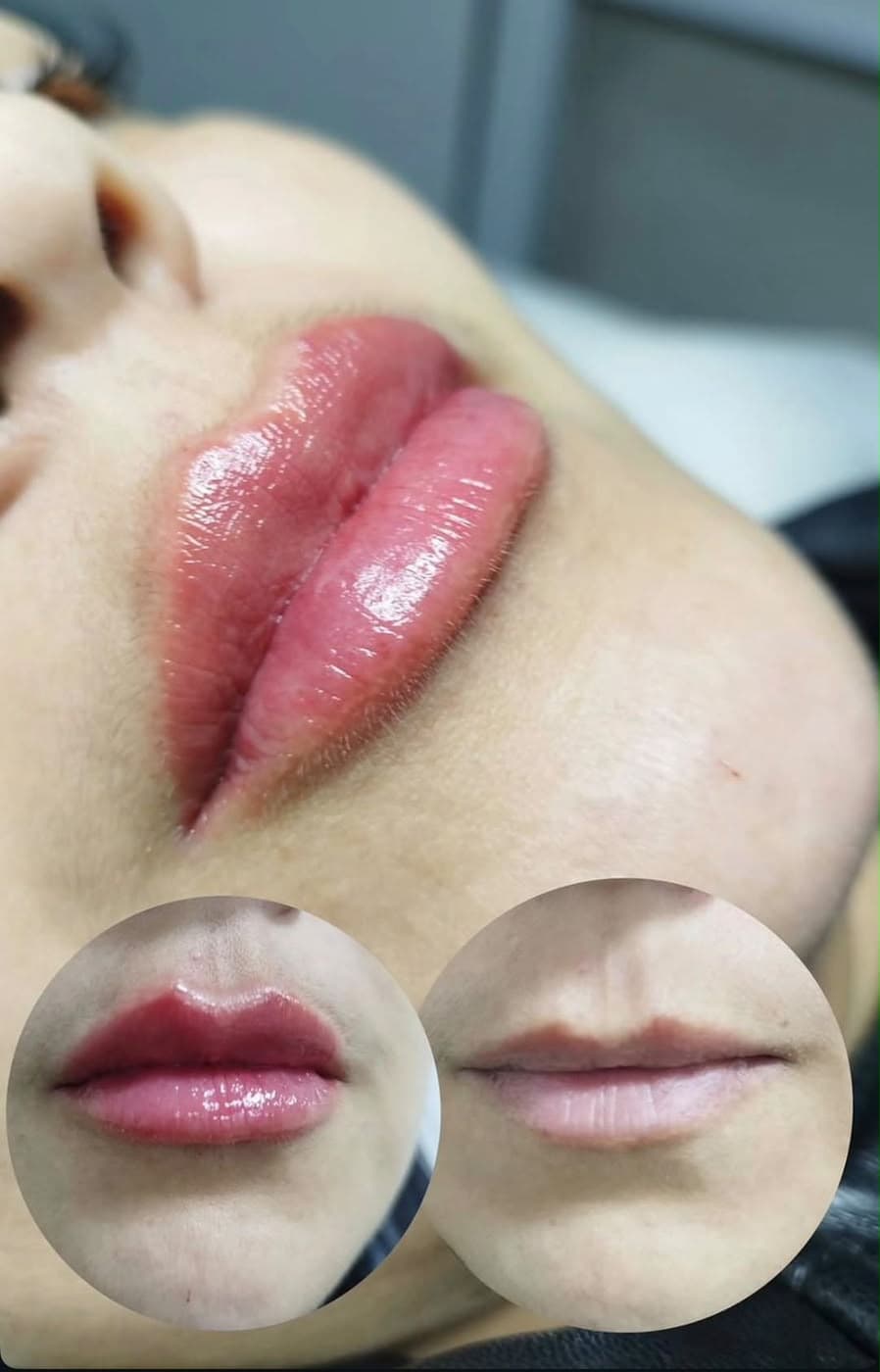 Comparativo de preenchimento labial realizado na Apapele: nos círculos inferiores, o lábio antes do procedimento à direita e o resultado à esquerda; ao fundo, o desenho final em perfil