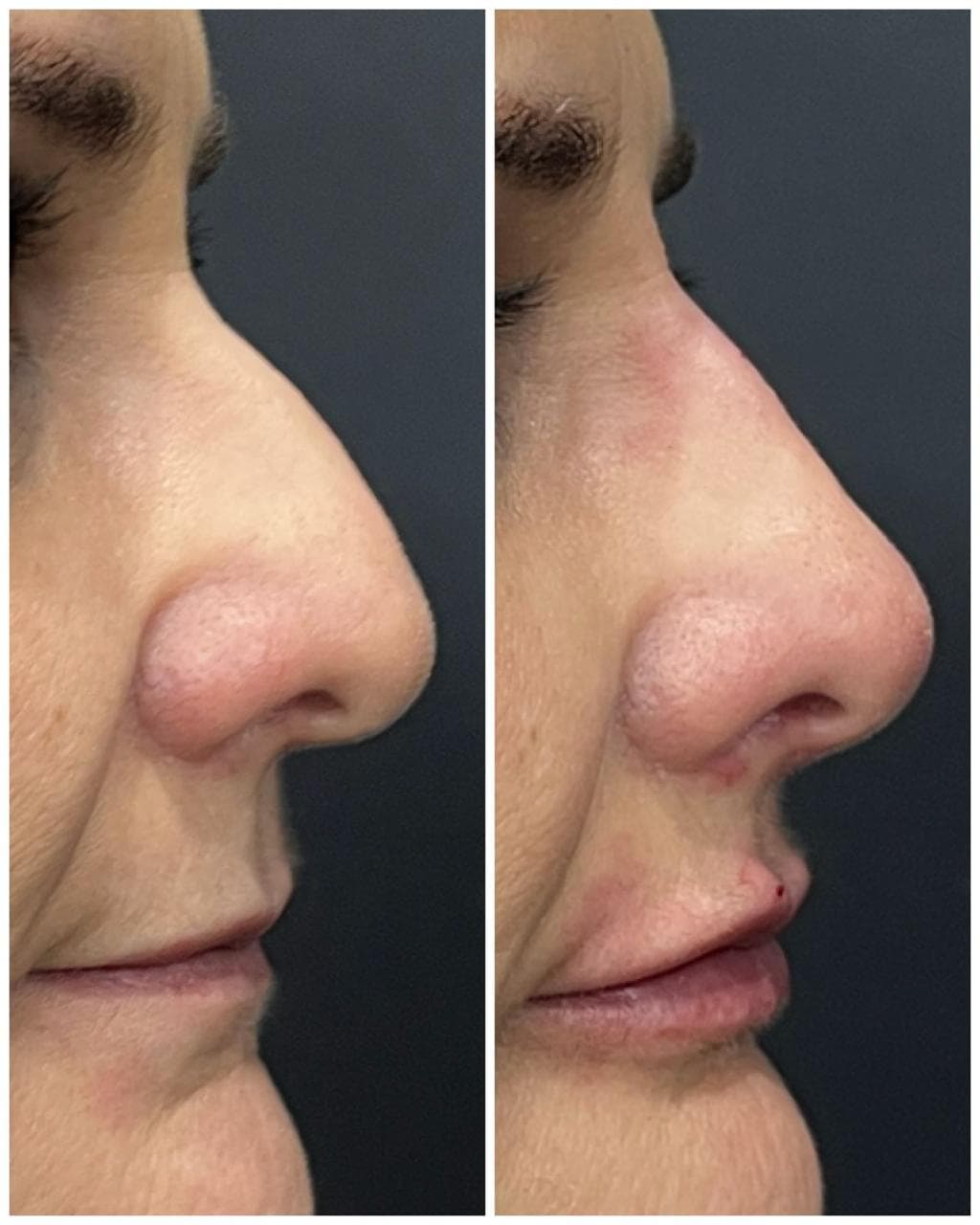 Segundo caso de rinomodelação na Apapele: perfil nasal fotografado no mesmo ângulo antes e depois da aplicação
