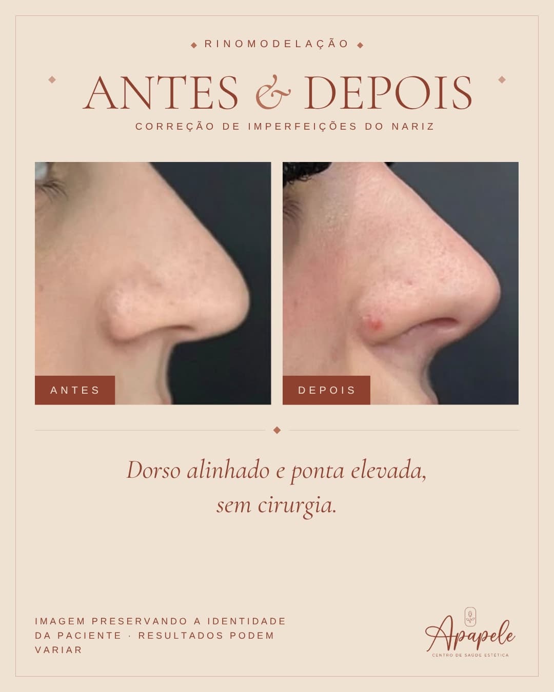Comparativo antes e depois de rinomodelação realizada na Apapele, com o perfil nasal da paciente fotografado no mesmo ângulo antes e depois do procedimento