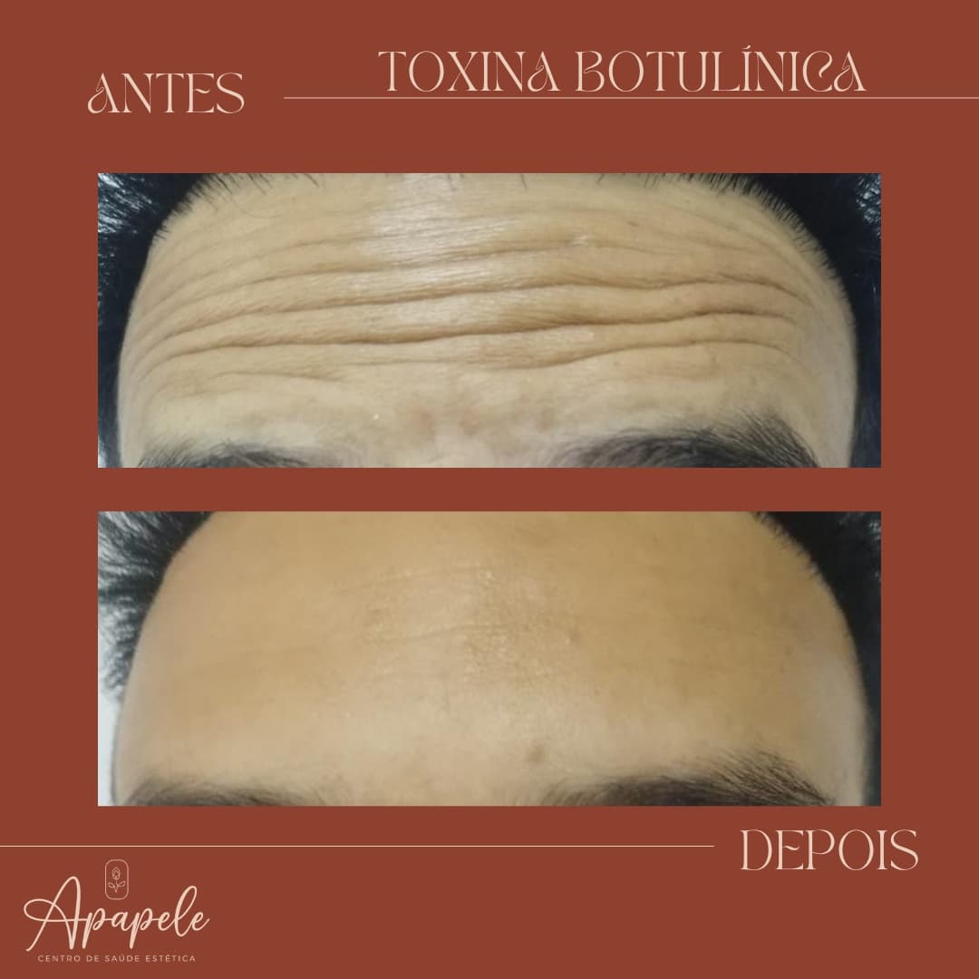 Comparativo antes e depois de toxina botulínica nas linhas da testa em paciente masculino, realizada na Apapele