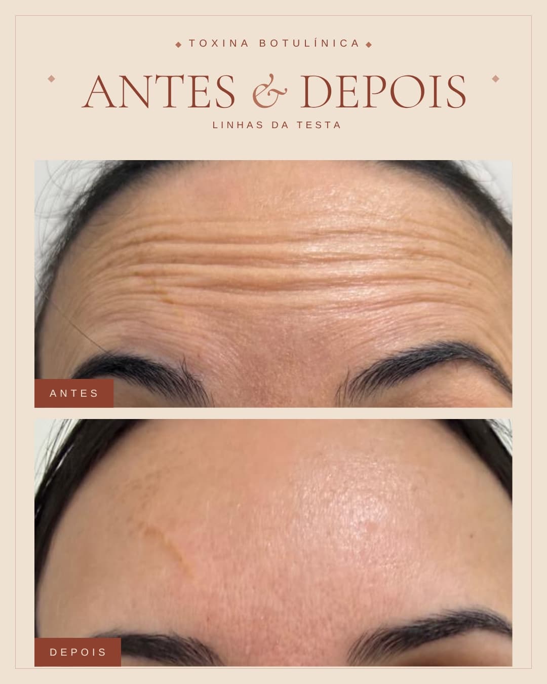 Comparativo antes e depois de toxina botulínica nas linhas da testa realizada na Apapele, com a testa da paciente fotografada no mesmo ângulo antes e depois do protocolo